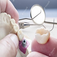 видове зъбни импланти - 22283 типа