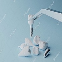 видове зъбни импланти - 11974 отстъпки