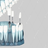 видове зъбни импланти - 2792 клиенти