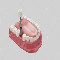 видове зъбни импланти - 21581 постижения