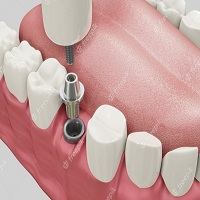 видове зъбни импланти - 74075 оферти