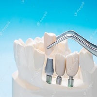 видове зъбни импланти - 48242 варианти